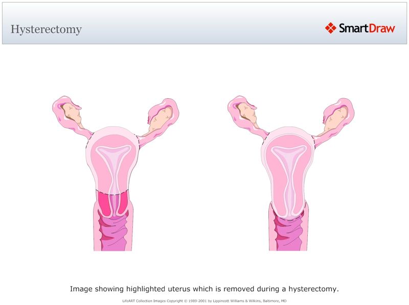 Hysterectomy
