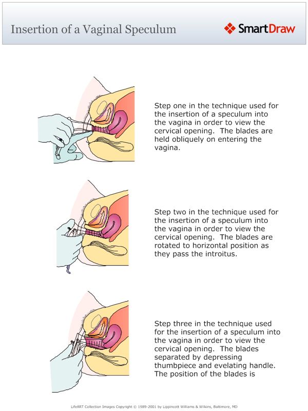 Insertion_of_a_Vaginal_Speculum