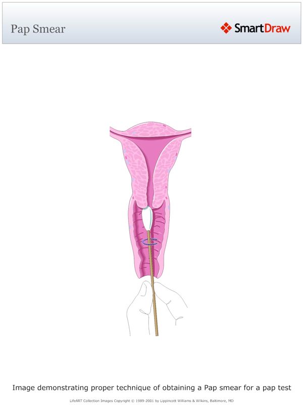 Pap_Smear