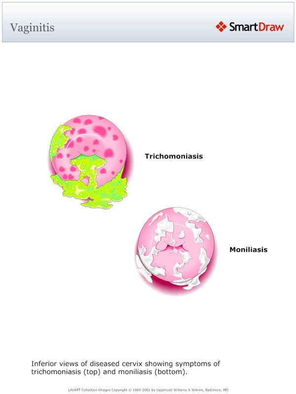Vaginitis
