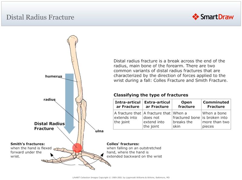 Distal_Radius_Fracture