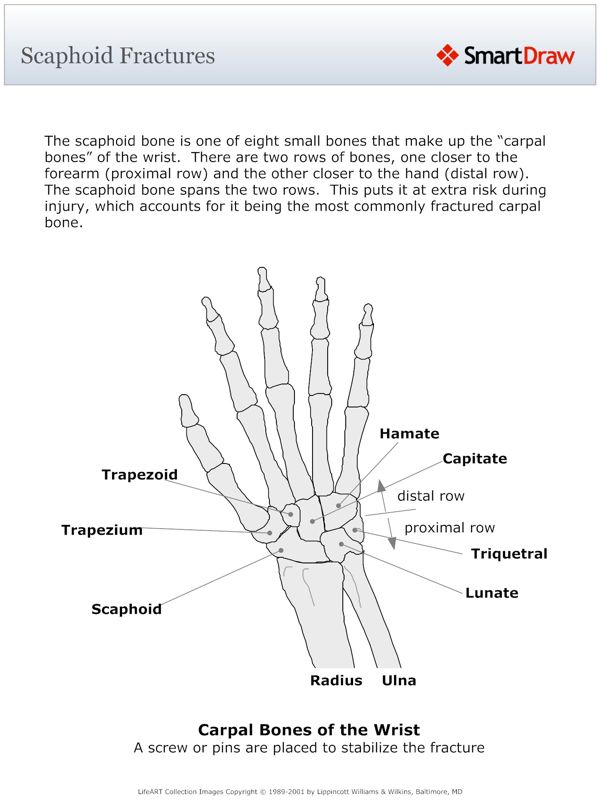 Scaphoid_Fractures