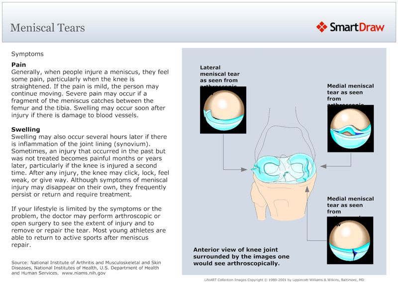 Meniscal_Tears2