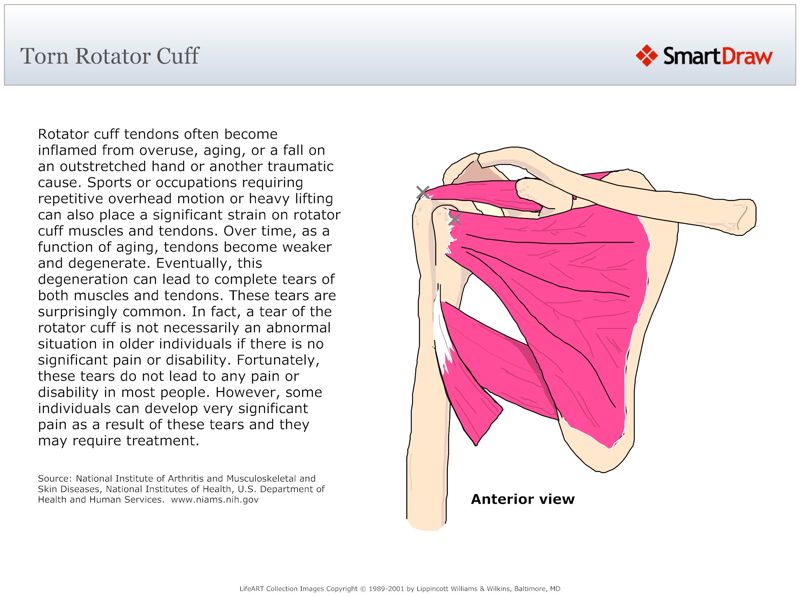 Torn_Rotator_Cuff