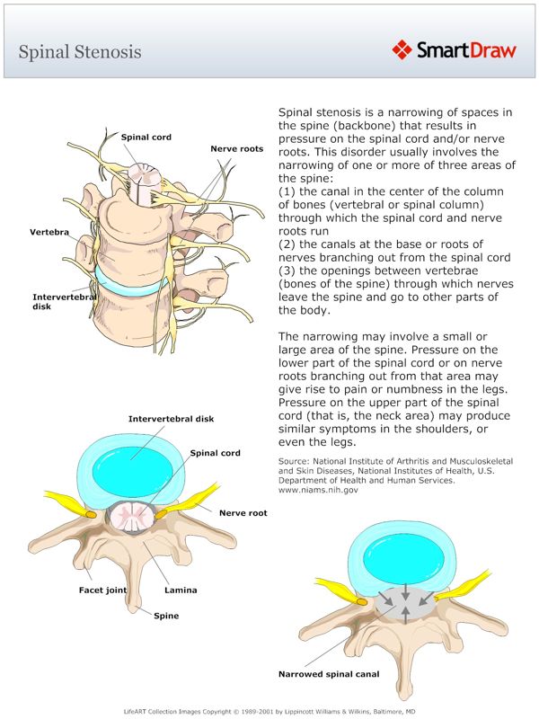 Spinal_Stenosis