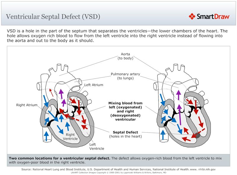 Ventricular_Septal_Defect_(VSD)