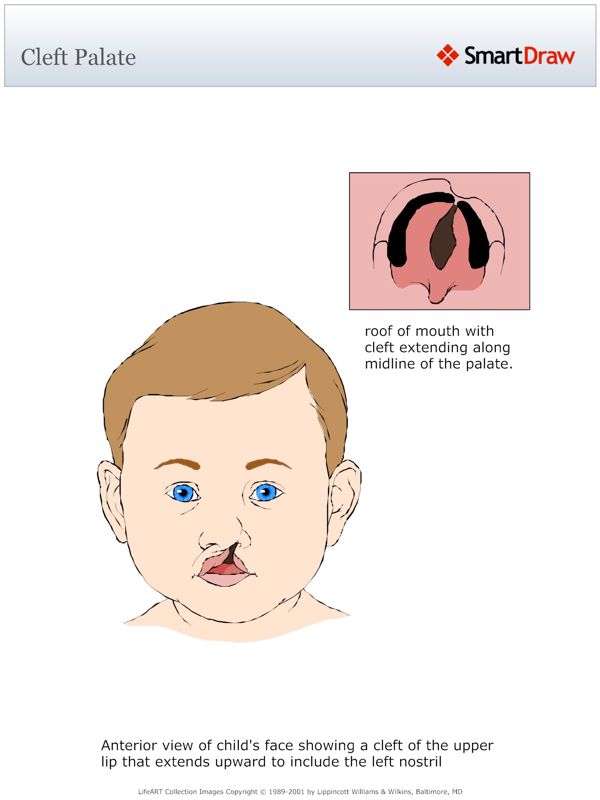 Cleft_Palate