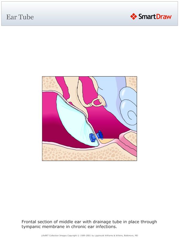 Ear_Tube