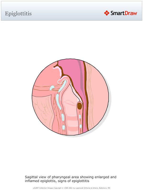 Epiglottitis