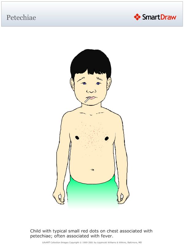 Petechiae