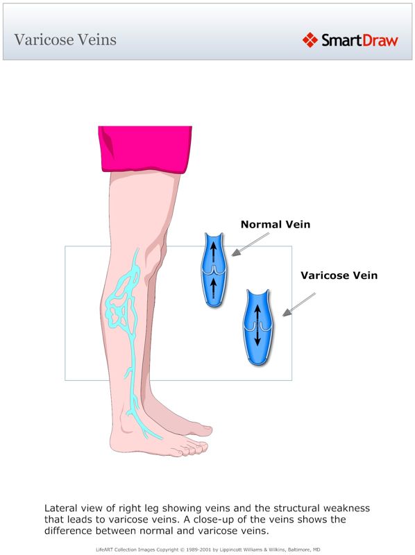 Varicose_Veins