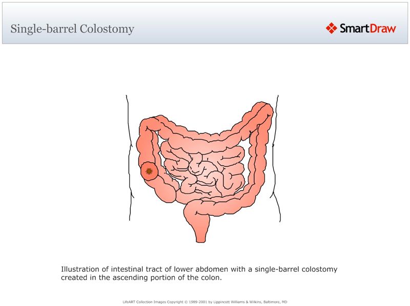 Single-barrel_Colostomy