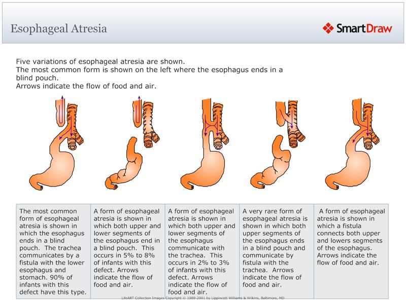Esophageal_Atresia
