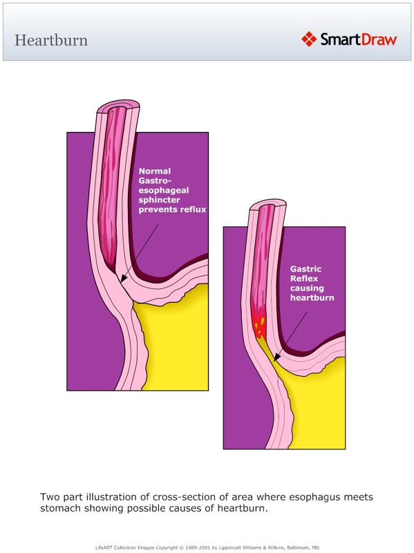 Heartburn