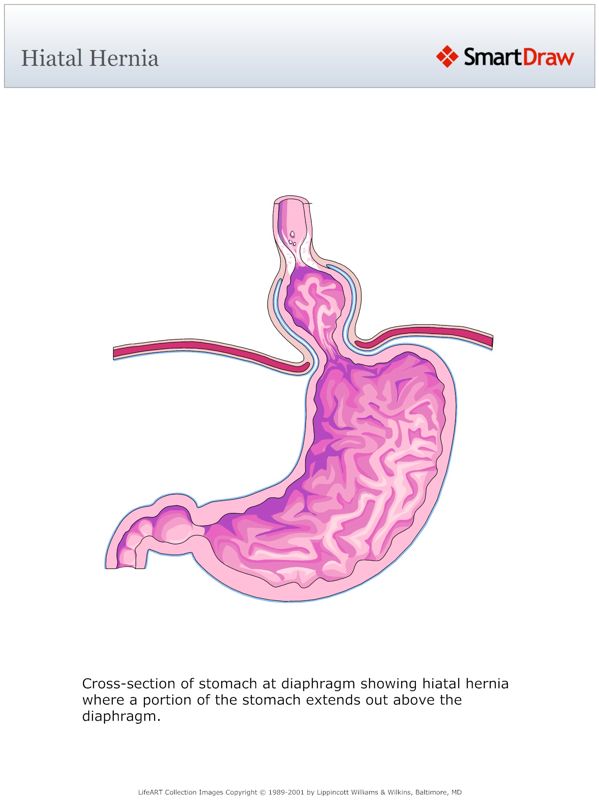 Hiatal_Hernia