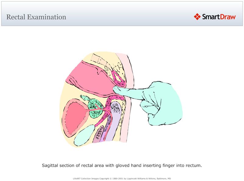 Rectal_Examination