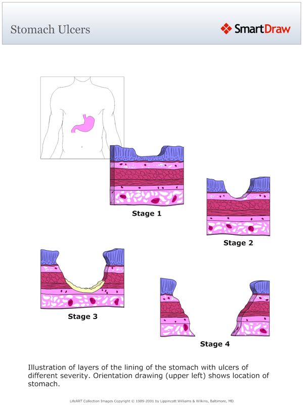 Stomach_Ulcers