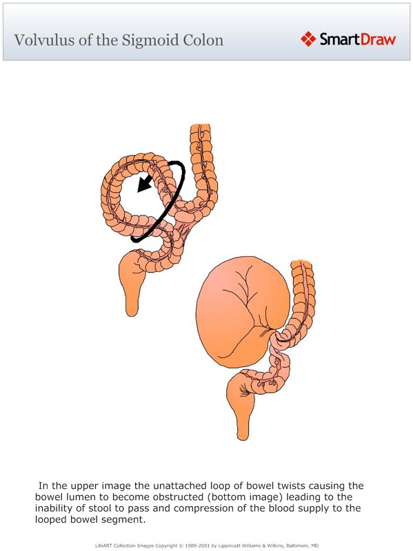 Volvulus_of_the_Sigmoid_Colon