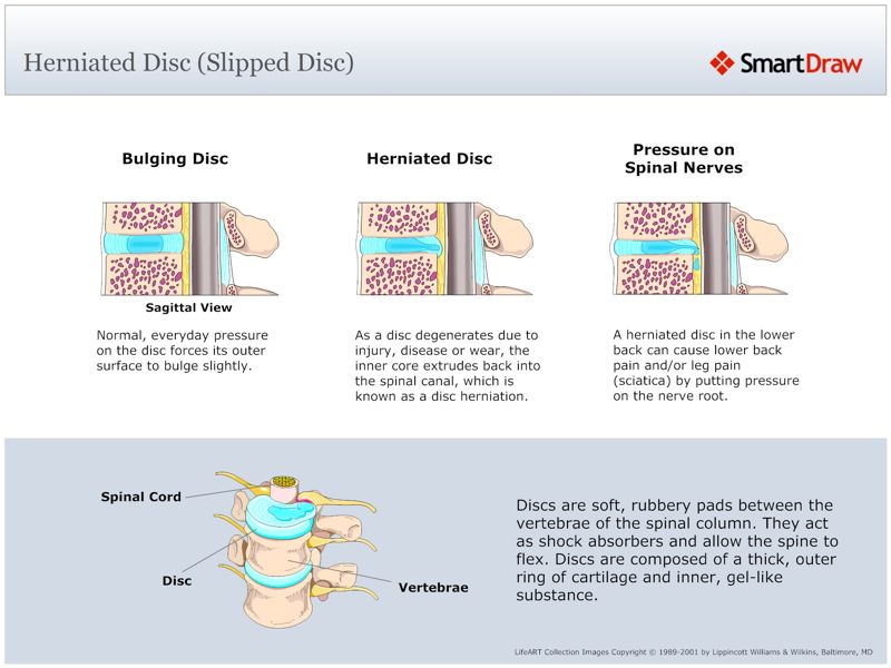 Herniated_Disc_(Slipped_Disc)