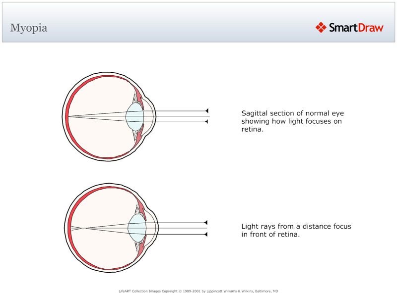 Myopia