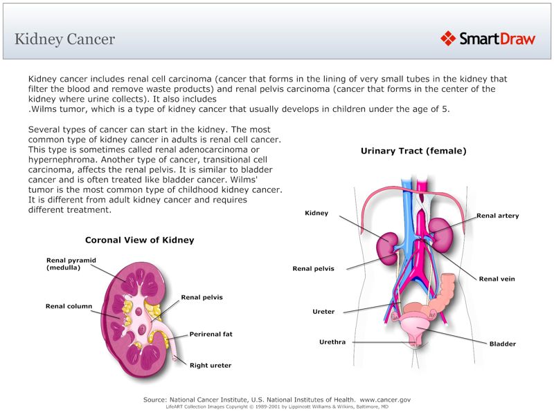 Kidney_Cancer