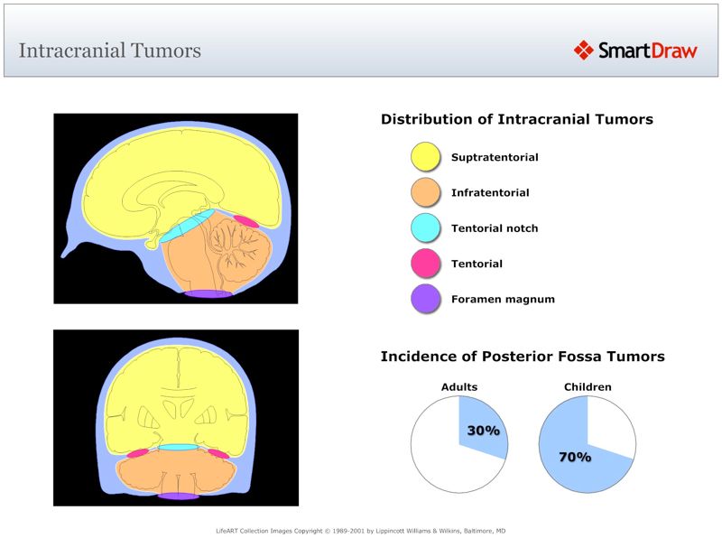Intracranial_Tumors