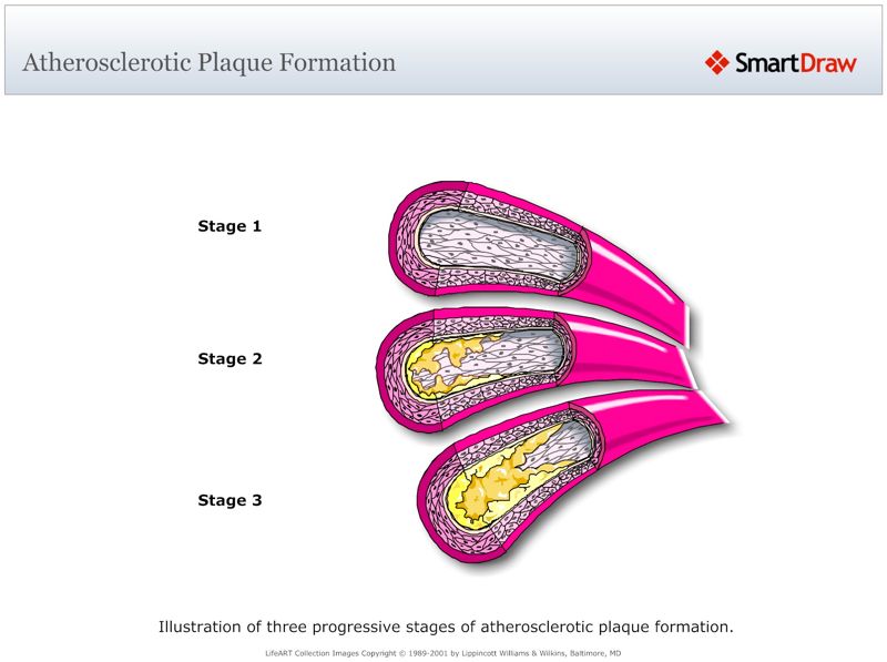 Atherosclerotic_Plaque_Formation
