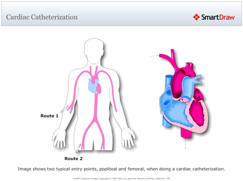 Cardiac_Catheterization