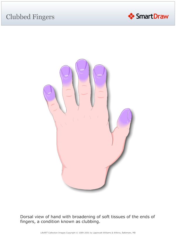Clubbed_Fingers