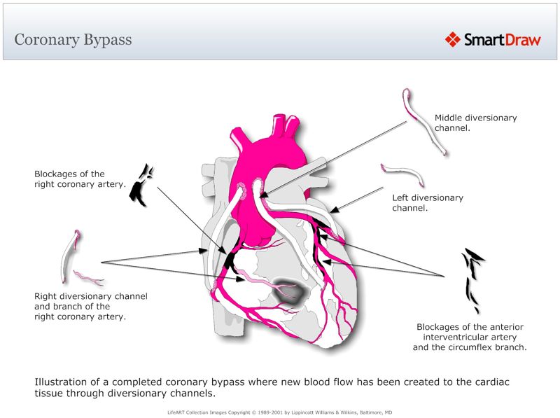 Coronary_Bypass