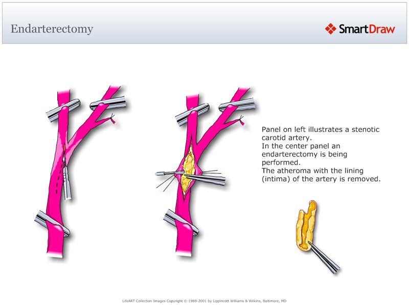 Endarterectomy