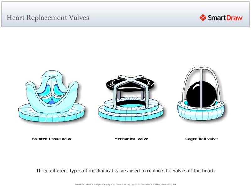 Heart_Replacement_Valves