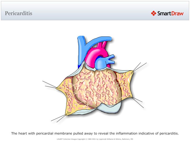 Pericarditis