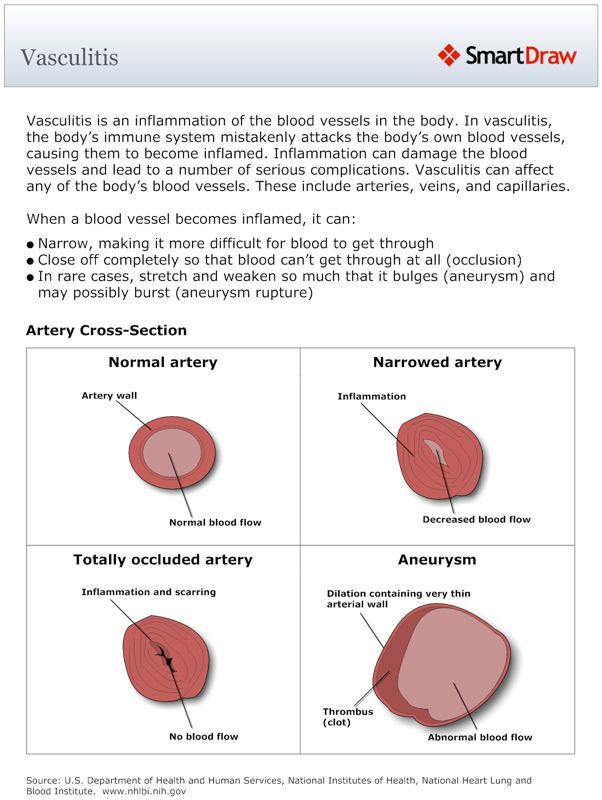 Vasculitis