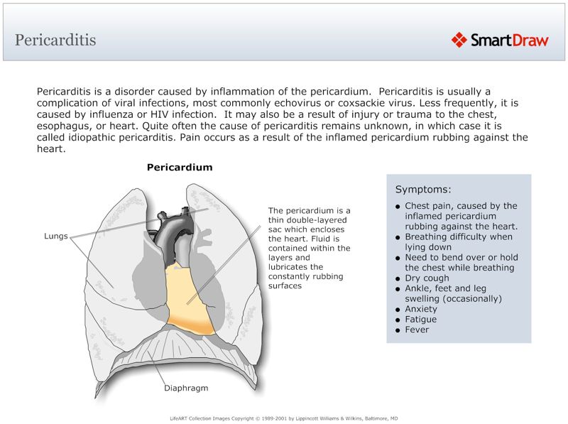Pericarditis