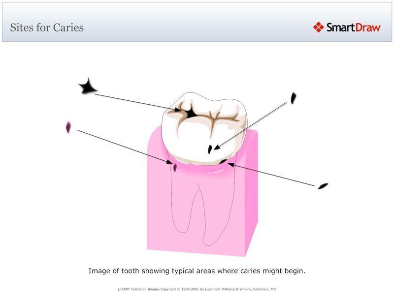 Sites_for_Caries