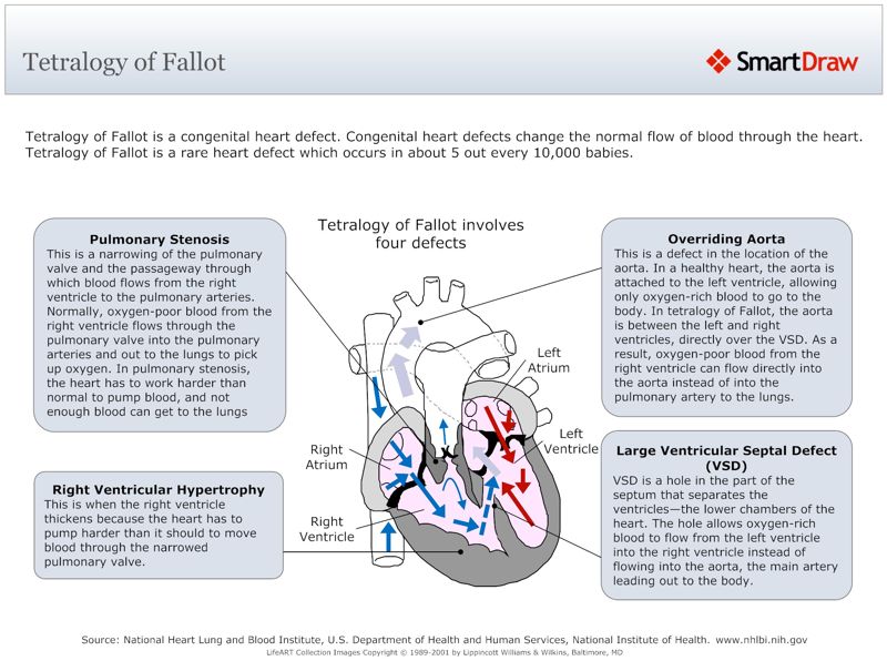 Tetralogy_of_Fallot