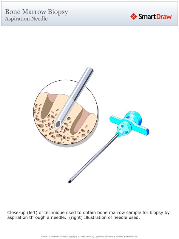 Bone_Marrow_Biopsy