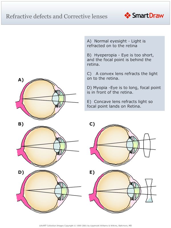 Refractive defects and Corrective lenses