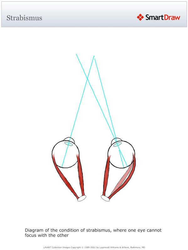 Strabismus
