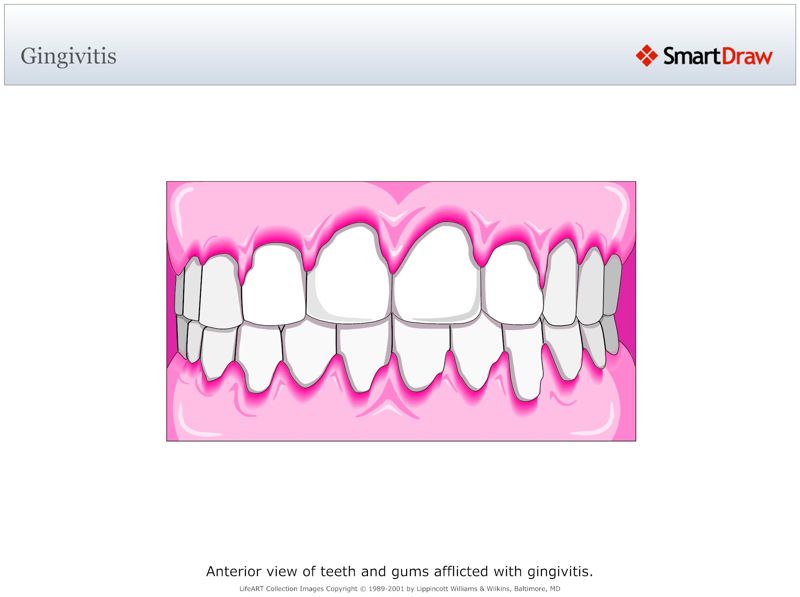Gingivitis