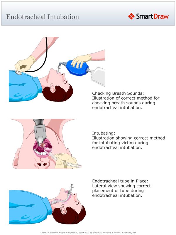Endotracheal_Intubation