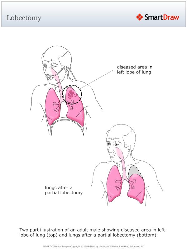 Lobectomy