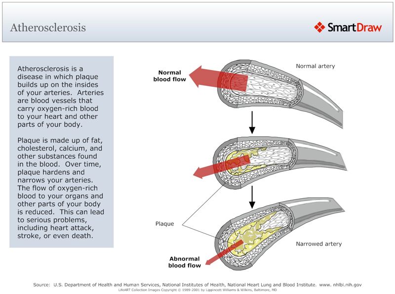 Atherosclerosis