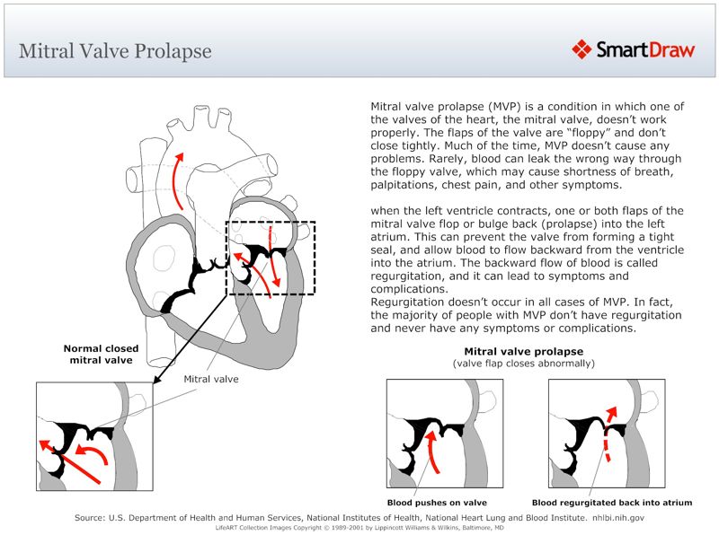 Mitral_Valve_Prolapse