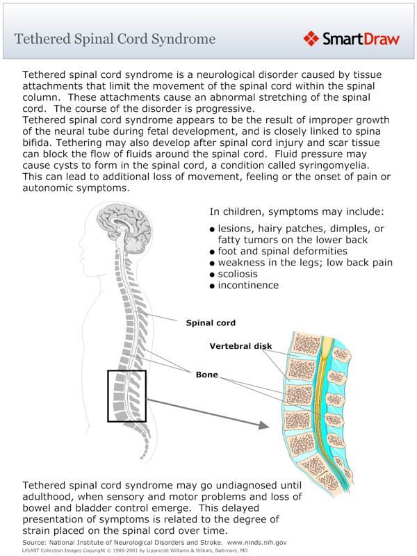 Tethered_Spinal_Cord_Syndrome