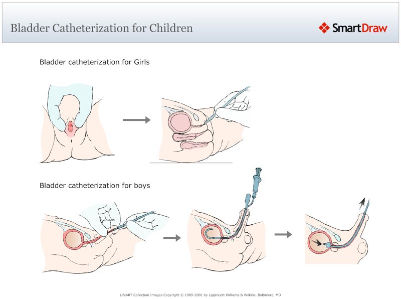 Bladder_Catheterization_for_Children