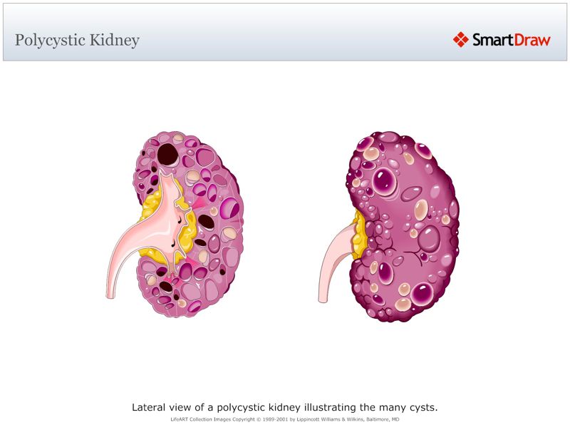 Polycystic_Kidney