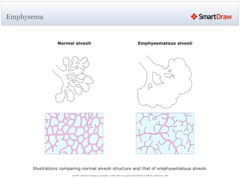 Emphysema