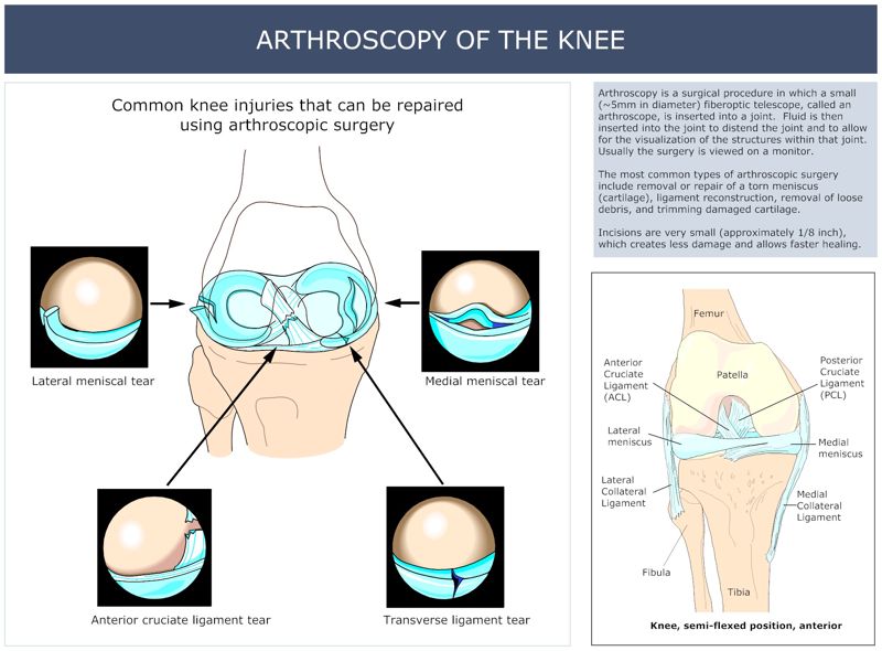 ARTHROSCOPY_OF_THE_KNEE